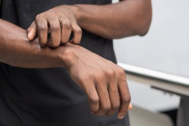 adam kaşıntı deri acı; derisi ile Anti, döküntü, mantar hastalığı, tinea sorun tırmalamak hasta Afrika adam; Sağlık, Cilt Bakımı, Dermatoloji kavramı; Yetişkin Afrika adam, siyah adam modu