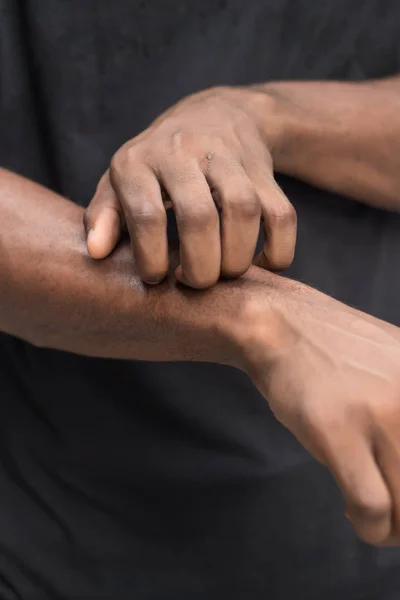 man suffering from itching skin; sick african man scratching his skin with allergy, rash, ringworm, tinea problem; health care, skin care, dermatology concept; adult african man, black man mode