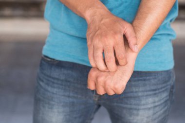 adam kaşıntılı cilt çizilmeye; Egzama kavramı, sivrisinek ısırığı, Dang, sıtma, sarı, Zika Fever hastalığı iletimi