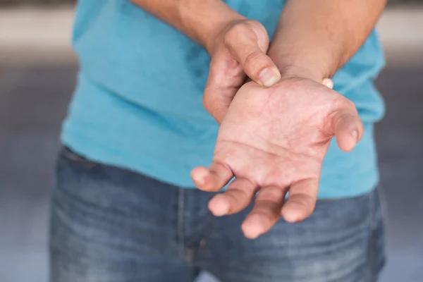 Mann Leidet Handgelenkschmerzen Karpaltunnelsyndrom — Stockfoto