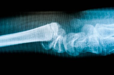 Röntgen film iskelet insan kolu. sağlık tıbbi anatomi vücut kavramı