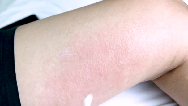 皮膚にアレルギー性のかぶれ皮膚炎湿疹 人間の足にアトピー性皮膚炎症状で外部使用のための薬剤のアプリケーション — ストック動画
