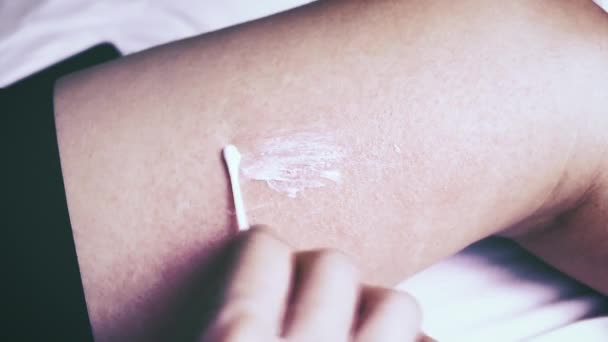 Alergická Vyrážka Dermatitida Ekzém Kůži Aplikace Léčiva Pro Zevní Použití — Stock video