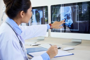 Genç bayan doktor masada oturuyor ve bilgisayardaki hastanın kafatası röntgenine işaret ediyor. Hastalık sorununu inceliyor.