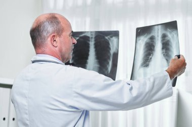 Pratisyen hekim pnömoni ile hastanın iki göğüs röntgenini karşılaştıran