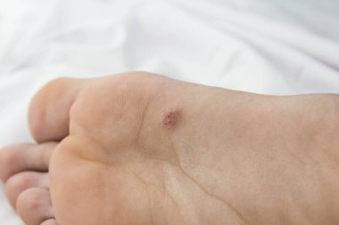 skin.close kadar sorun alanları ile ayak