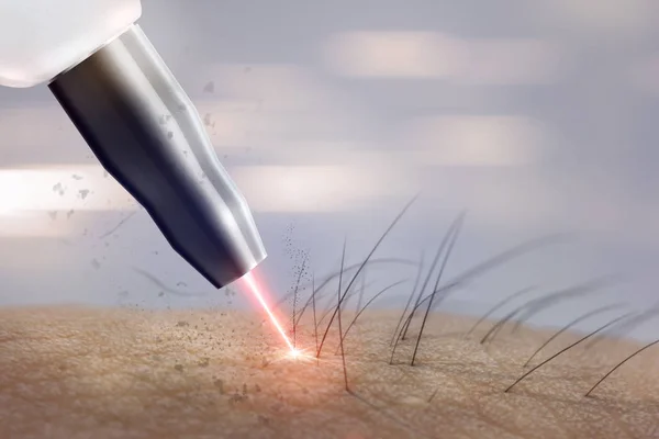 Kozmetik prosedür lazer epilasyon vücut parçaları üzerinde. Lazer epilasyon.