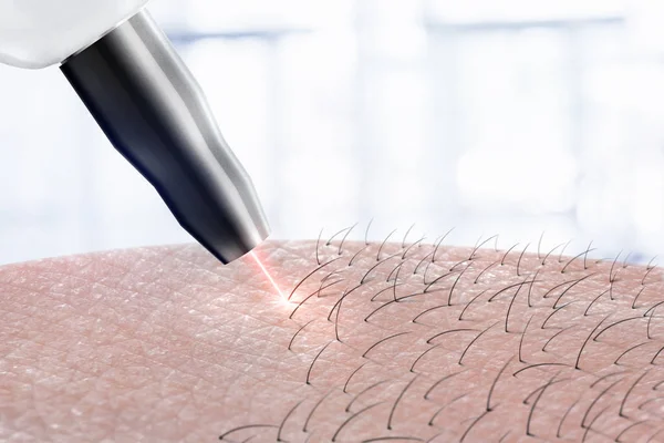 Kozmetik prosedür lazer epilasyon vücut parçaları üzerinde. Lazer epilasyon.