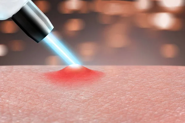 Kosmetologia Procedury Laserowe Usuwanie Trądziku Części Ciała Bliska — Zdjęcie stockowe