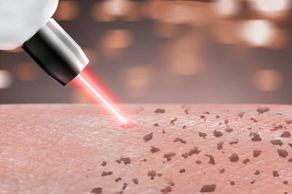 Kozmetik prosedür lazer çil cilt temizleme vücut parçaları üzerinde. yakın çekim
