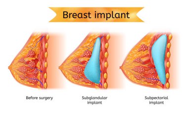 Brest Implant prosedürü vektör anatomik sepeti