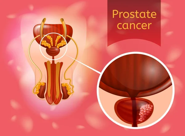 Prostate Cancer Realistic Vector Anatomical Scheme — Stock Vector