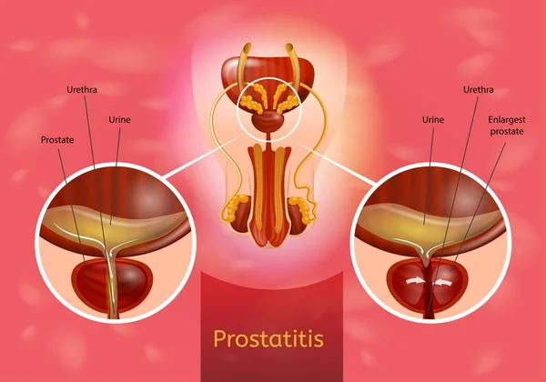 Prostatitis anatómia