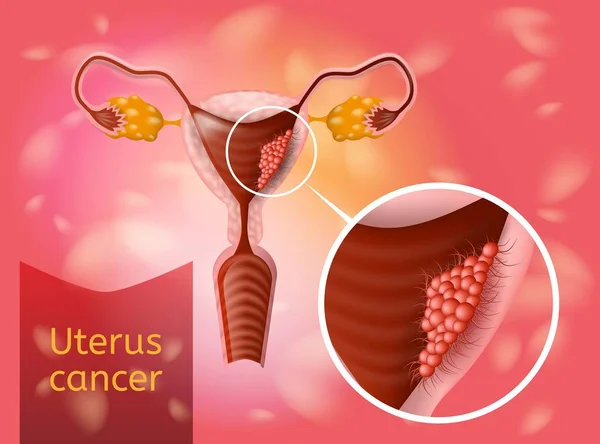 Cáncer uterino Vector realista Concepto de salud — Vector de stock