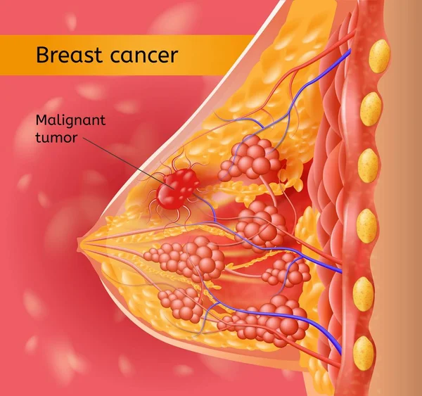 Femme Brest Cancer Vector Anatomical Scheme — Image vectorielle