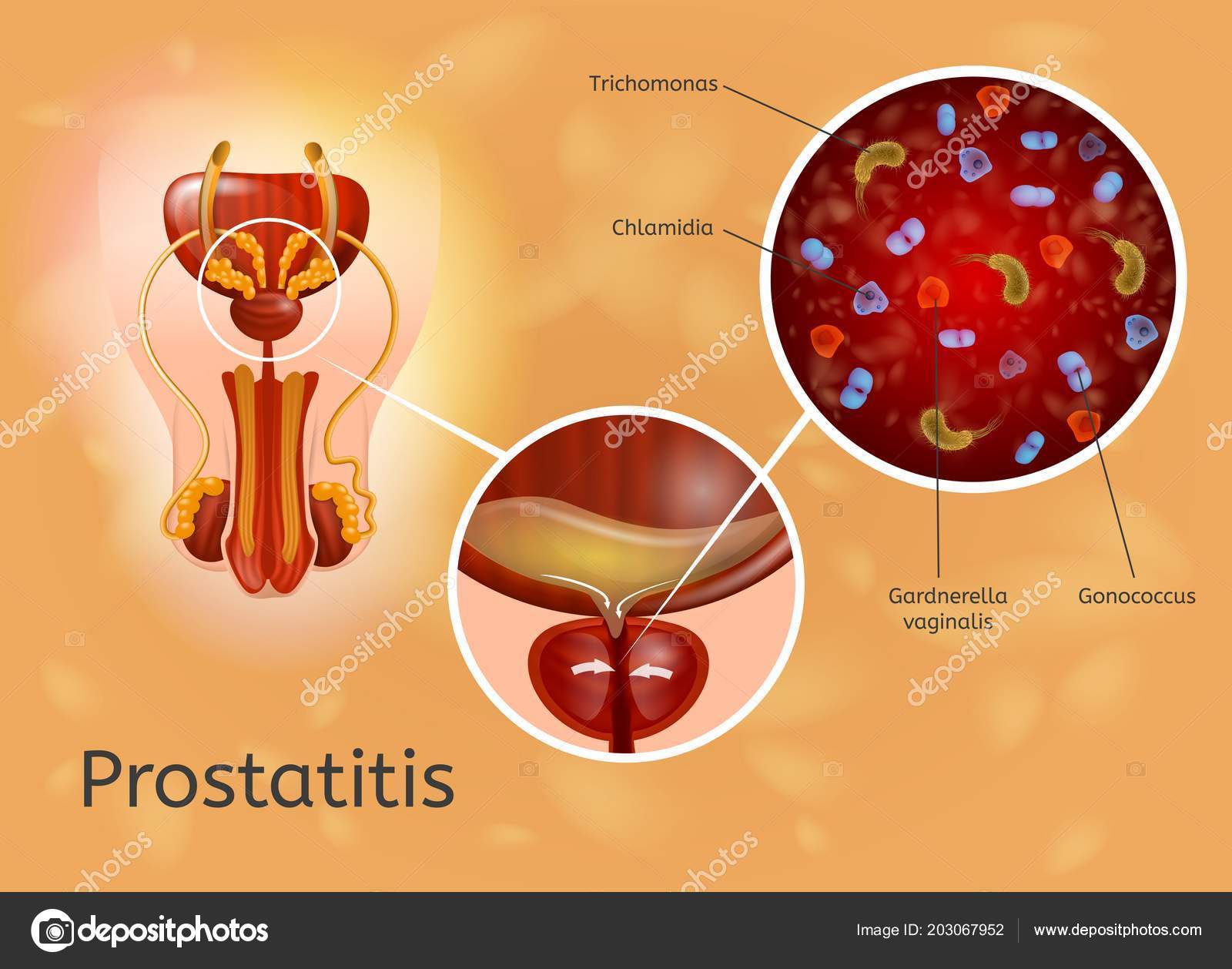 prostatitis lehet trichomoniasis)