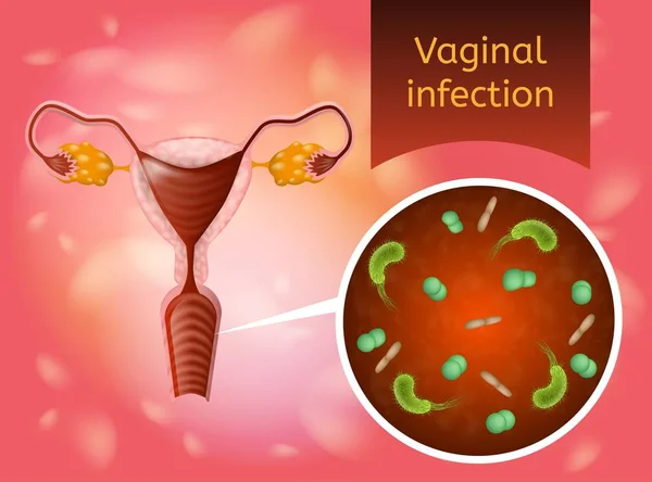 Vaginale infectie realistische Vector Concept — Stockvector
