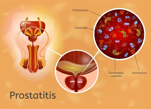 Prostatite Doença Causas Explicação Vetor —  Vetores de Stock