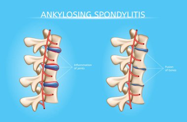 Spine Joints Arthritis Symptoms Vector Infographic clipart