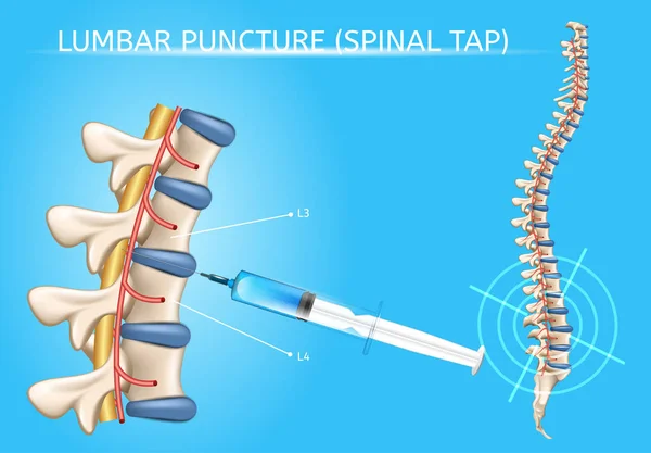 Lumbar Puncture Realistic Vector Medical Scheme — Stock Vector