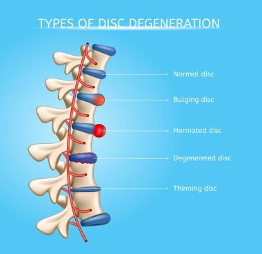 İntervertebral disk dejenerasyonu türleri vektör