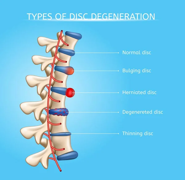 Tipos de degeneración del disco intervertebral Vector — Archivo Imágenes Vectoriales