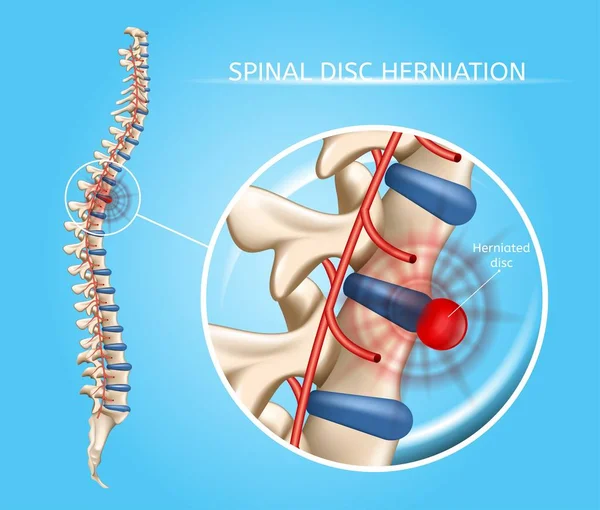 Spinale schijf Herniation Vector medische regeling — Stockvector