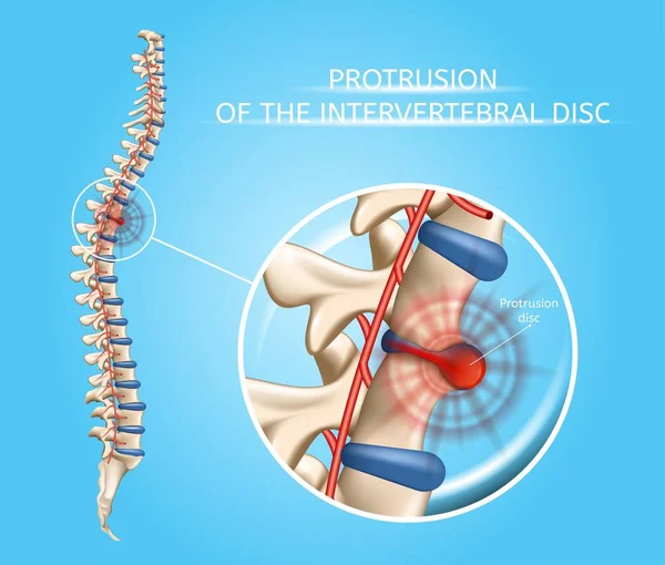 Enfermedad de la columna vertebral humana Vector Infografía anatómica — Archivo Imágenes Vectoriales