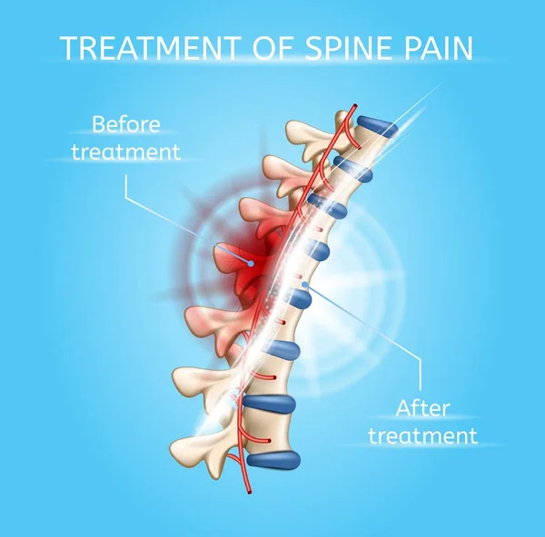 Treatment of Spine Pain Realistic Vector Chart — Stock Vector