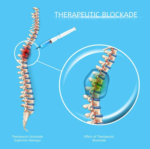Therapeutic Blockage of Spine Diseases Vector — Stock Vector