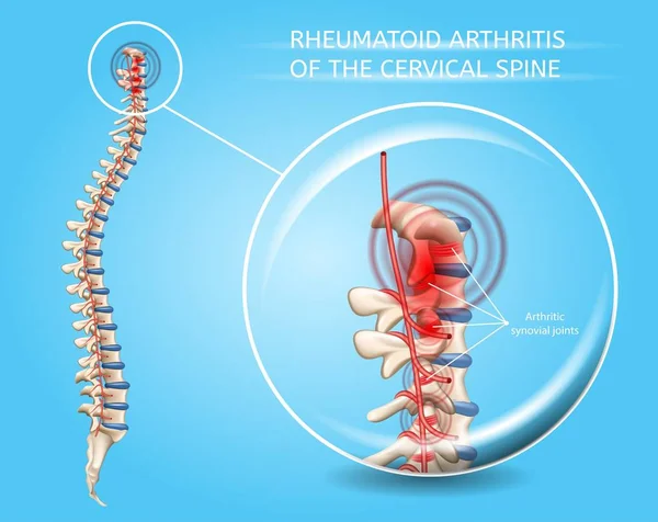 Polyarthrite rhumatoïde du vecteur de la colonne cervicale — Image vectorielle