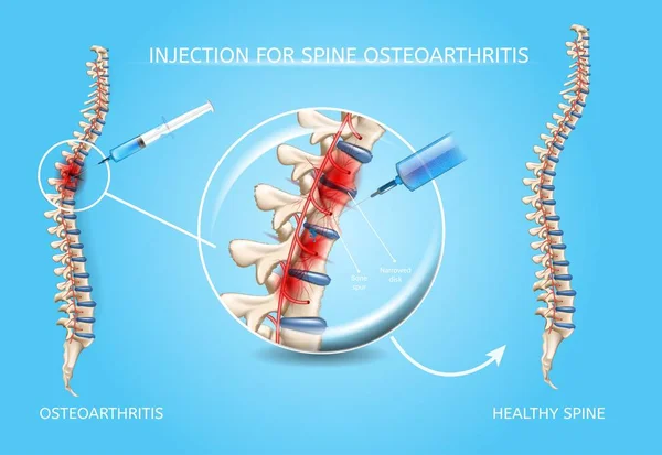 Osteoartrite da coluna Vetor de tratamento médico —  Vetores de Stock