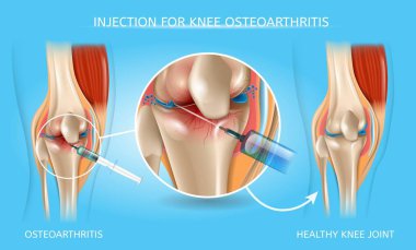 Enjeksiyon diz osteoartrit tıbbi grafik için
