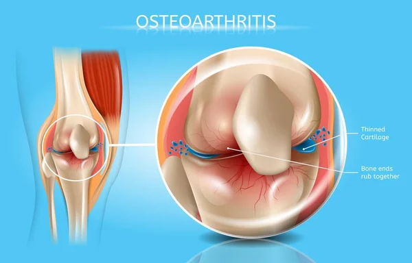 Realistisches Vektor-medizinisches Schema für Arthrose — Stockvektor