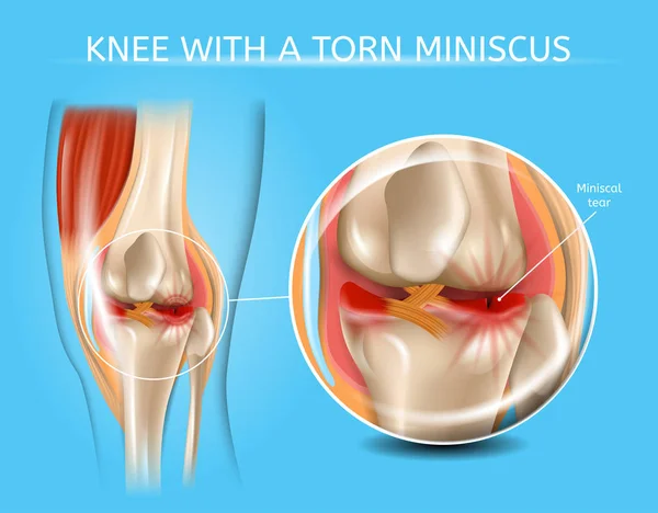 损伤的膝关节与撕裂半月板向量图 — 图库矢量图片
