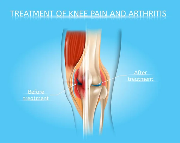 Knieschmerzen und Arthritis-Behandlung Vektordiagramm — Stockvektor