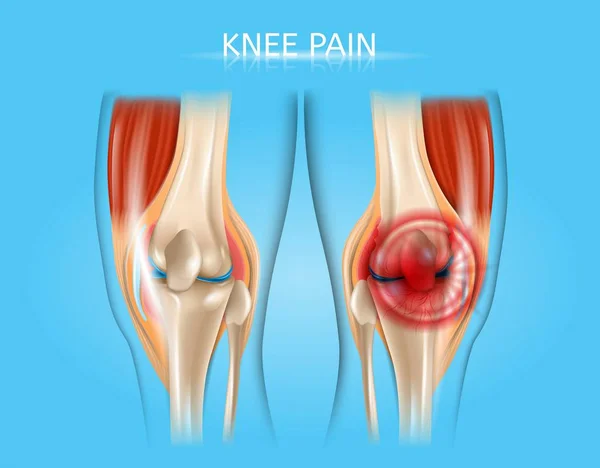 Diz ağrısı gerçekçi vektör anatomik çizim — Stok Vektör