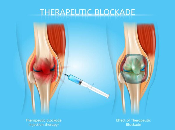 Therapeutic Blockage with Injection Therapy Vector