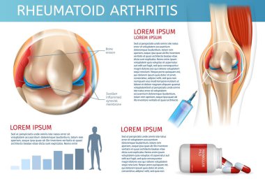 Infographic tedavi yöntemi romatoid artrit