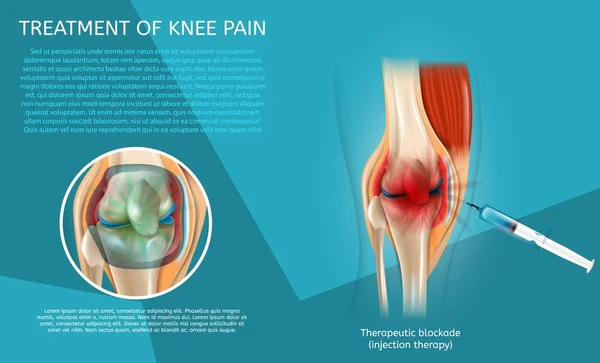 Tratamiento de ilustración realista del dolor de rodilla — Archivo Imágenes Vectoriales
