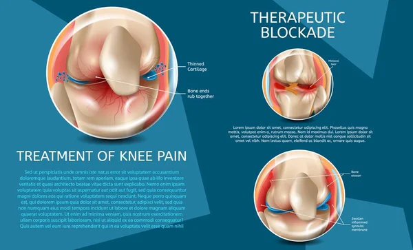 Illustration réaliste Traitement de la douleur au genou — Image vectorielle