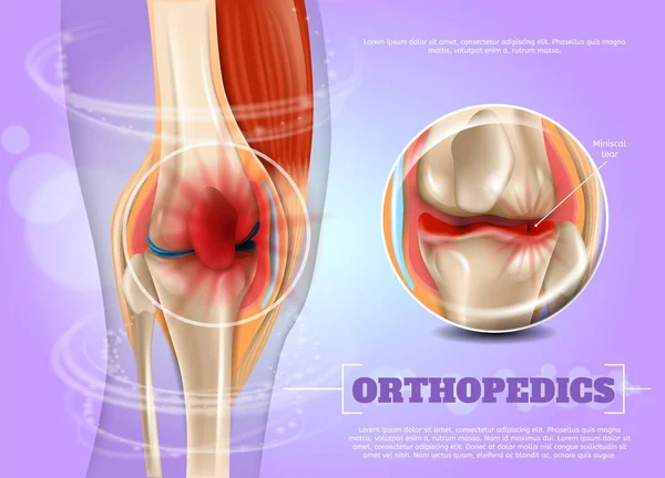 Realistic Illustration Orthopedics Medicine in 3d — Stock Vector