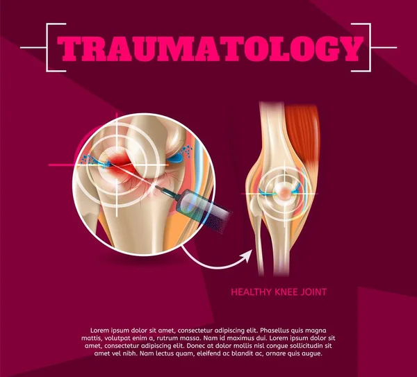 Realistic Illustration Traumatology Medicine in 3d — Stock Vector