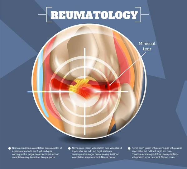 Realistic Illustration Reumatology Medicine in 3d - Stok Vektor
