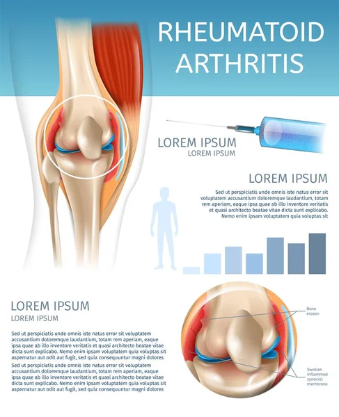 Infographic Treatment Method Rheumatoid Arthritis — Stock Vector