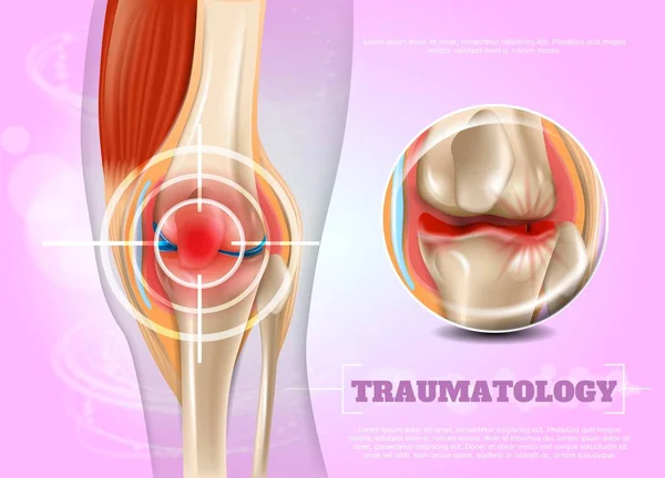 Gerçekçi illüstrasyon Traumatologe tıp 3D — Stok Vektör