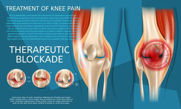 Реалістична ілюстрація лікування болю в коліні — стоковий вектор