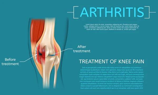 膝关节疼痛的真实图解治疗 — 图库矢量图片