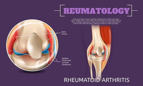 Реалістична ілюстрація ревматоїдний артрит коліна — стоковий вектор