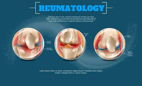Realistische Banner afbeelding Reumatology Vector — Stockvector
